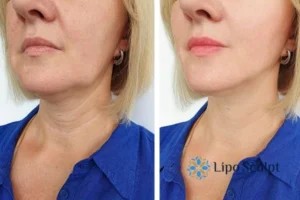 Double chin before and after Hi-Fu treatment 4 Book your double chin treatment Selston today! We are here to help!