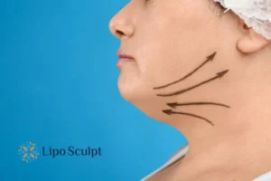 Double chin before and after Hi-Fu treatment 3 Boost your confidence with a Double chin treatment Selston