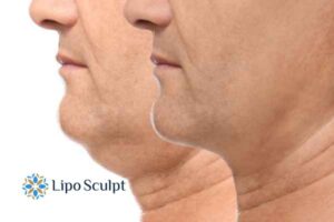 Double chin before and after Hi-Fu treatment 2 Double chin treatment Selston from Lipo Sculpt - feel more confident today!