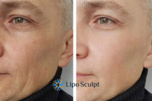 How to Fight Aging Symptoms 3 Fight Aging Symptoms Selston With HIFU and Morpheus8 Today!