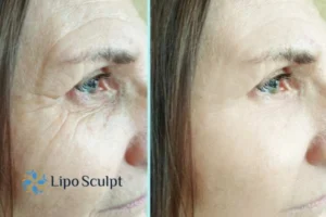 How to Fight Aging Symptoms 2 Do you want to Fight Aging Symptoms Selston? Contact Lipo Sculpt today!