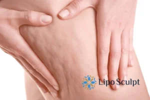 CoolSculpting for Legs: The Innovative Approach to Redefining Your Legs 5 Start your journey today book your coolsculpting treatment Selston online today!