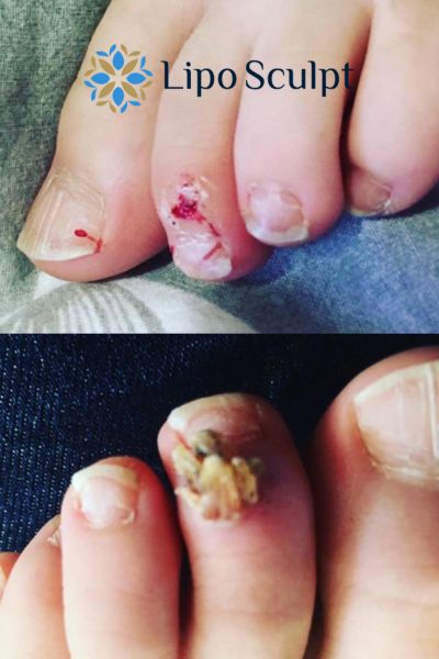 Wart removal customer results from Lipo Sculpt Selston