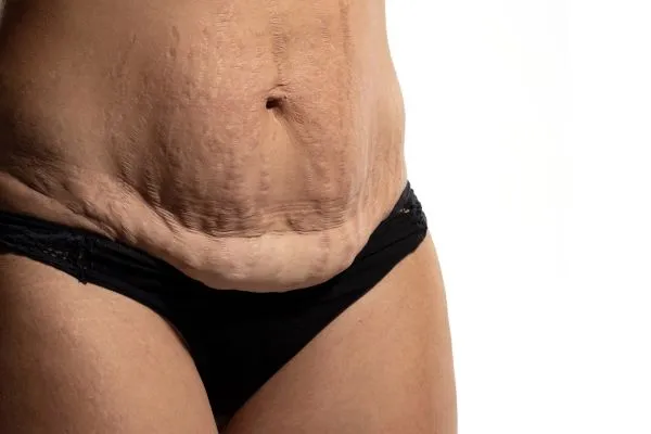 Lost the Weight but Not the Loose Skin? 1 image of womans stomach after weight loss showing loose skin Selston